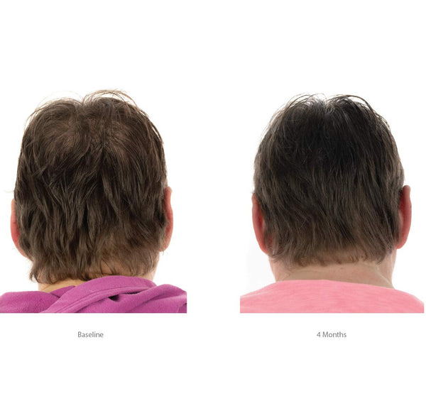 Kit de repousse des cheveux pour femmes FOLIGAIN