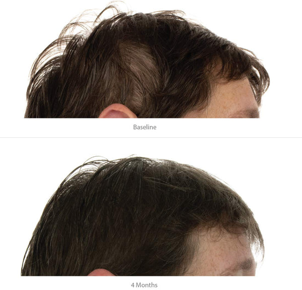 Kit de repousse des cheveux pour femmes FOLIGAIN